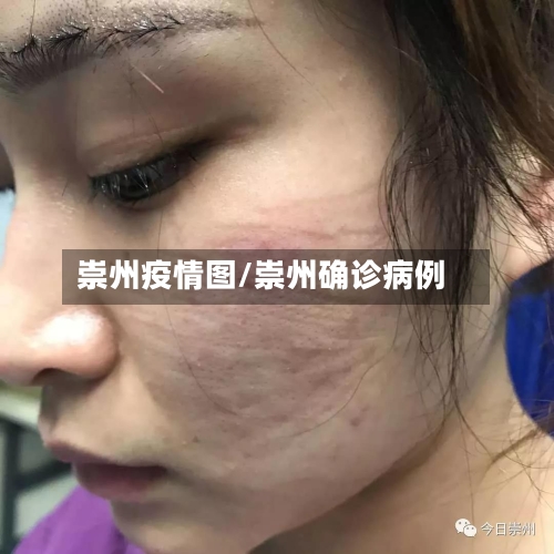 崇州疫情图/崇州确诊病例